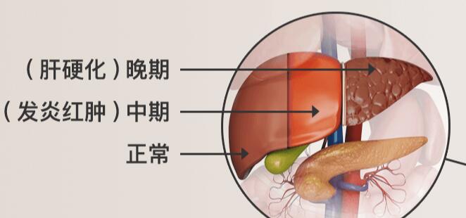 <b>丙肝需要接受治疗吗？丙肝病毒</b>