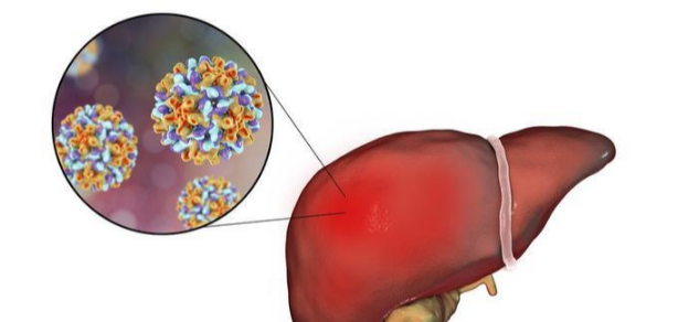 <b>乙肝核心抗体阳性是什么意思？需要进一步的治疗吗？</b>药厂实拍