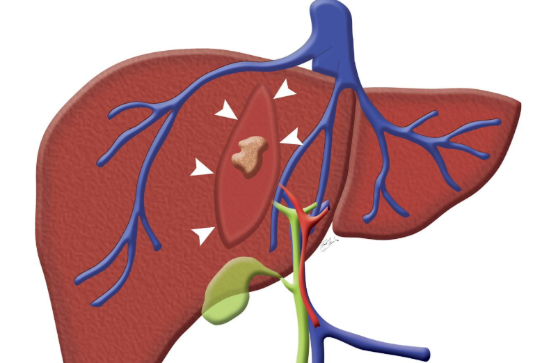 <b>为什么确认丙肝病毒需要检查抗-HCV？丙肝治疗的好吗？</b>药厂实拍