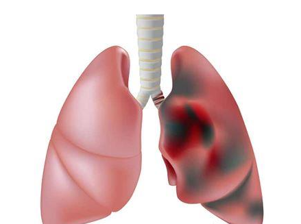 <b>肺癌的治疗有作用吗？小细胞肺</b>