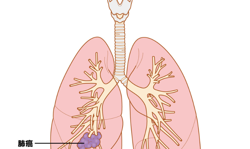 癌症,晚期,能活,多久,肺癌,病人,吃,什么,如果,