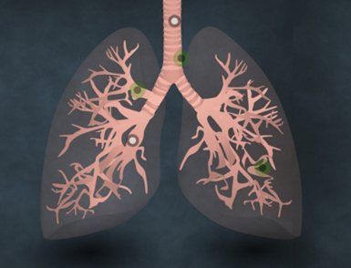 肺癌扩散的速度到底有多快？