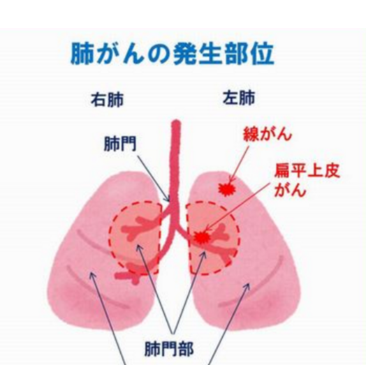 肺癌,晚期,怎么,治疗,一般用,什么,方式,肺癌,