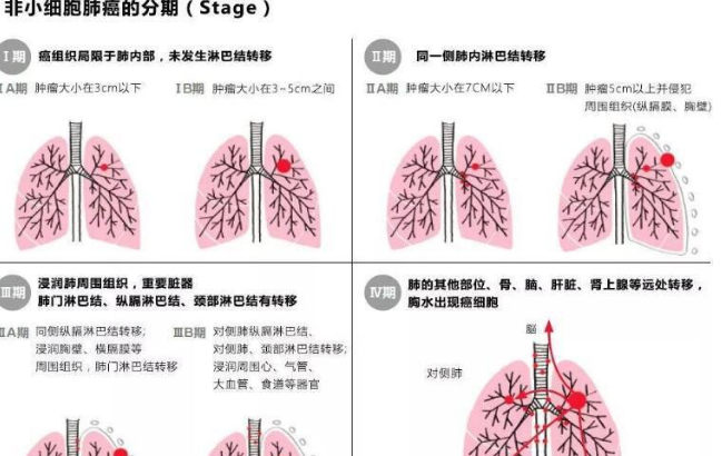 肺,癌的,生存,时间,是,多少,非,小细胞,肺癌,