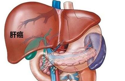 <b>肝癌的早期症状有哪些？肝癌治</b>