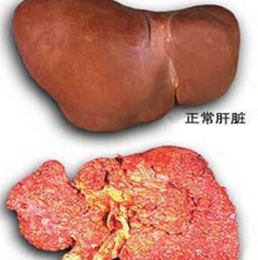 如何预防慢性乙型肝炎转变成肝癌？药厂实拍