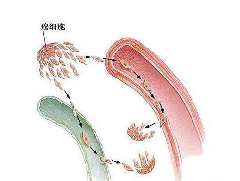 <b>肾癌转移会引起体内的肿瘤扩散</b>