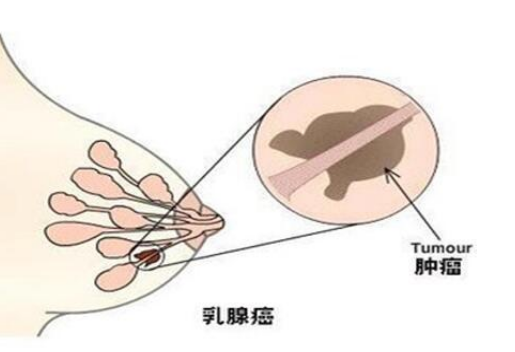 <b>转移性乳腺癌可以用21基因来检</b>