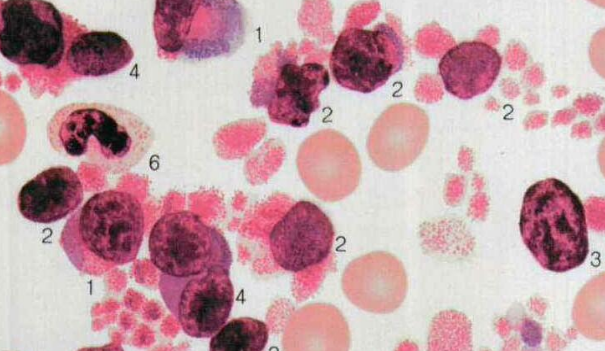 <b>什么是急性髓细胞白血病？白细胞可以得到控制吗？</b>药厂实拍
