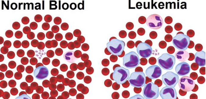 白血病的治疗方法有什么？效果