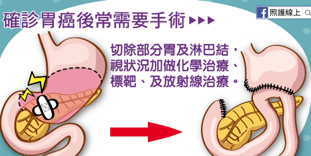 <b>PARP抑制剂FLUZOPARIB能治疗胃癌患者吗？</b>药厂实拍