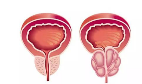 前列腺癌 前列腺增生 老年男性 肿瘤