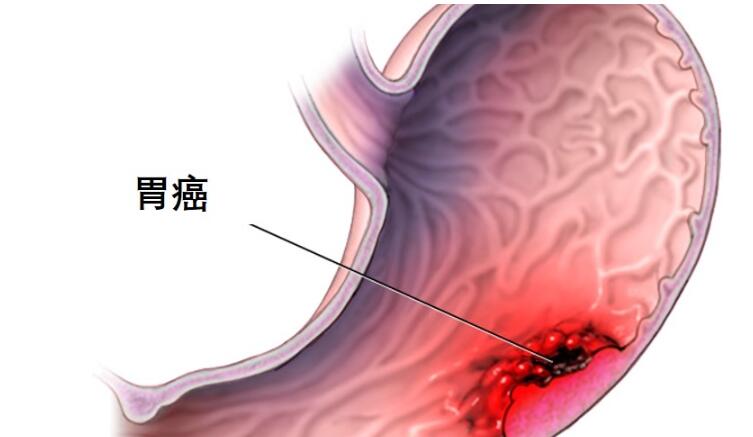 肠胃道系统瘤晚期