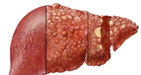 "肝癌,恶性肿瘤,丙肝,乙肝"