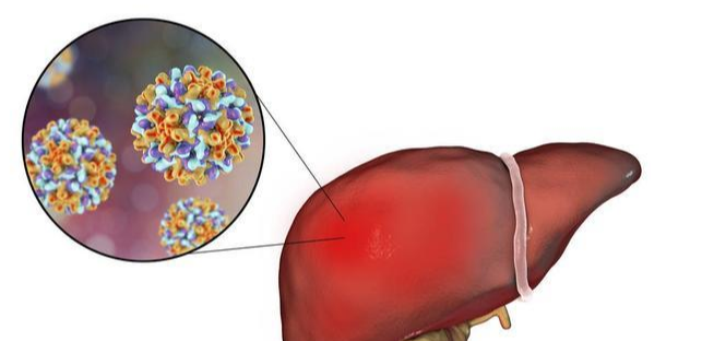 抗病毒,治疗,对,肝癌,患者,仍,重要,吗,抗病毒,