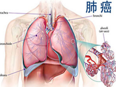 如何治疗非小细胞肺癌？服用易瑞沙之前需要进行基因测试吗？药厂实拍