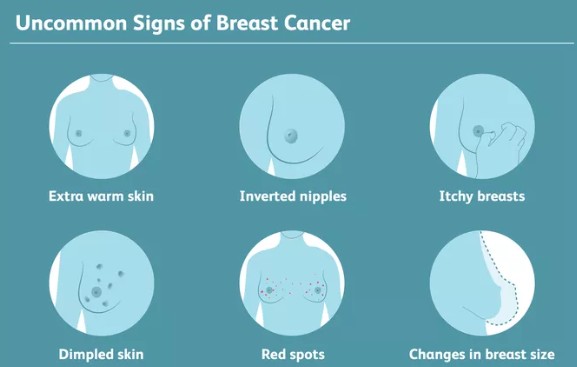 您可能没有听说过的6种乳腺癌罕见迹象药厂实拍