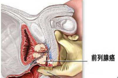 阿比特龙