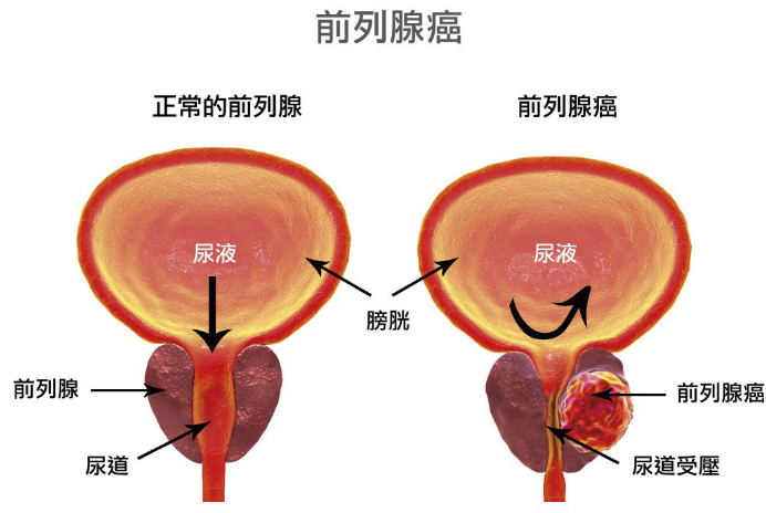 有关于阿比特龙的相关临床研究药厂实拍