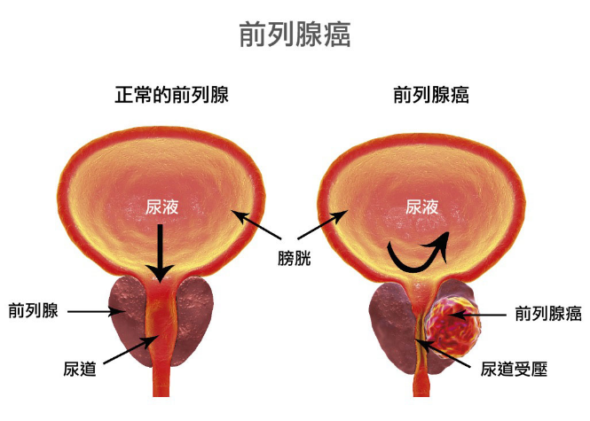 恩扎鲁胺被批准用于男性去势耐