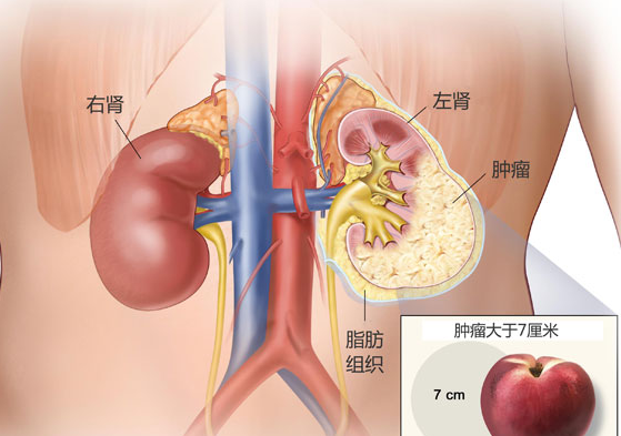 阿西替尼+AVELUMAB可用于治疗晚期肾癌