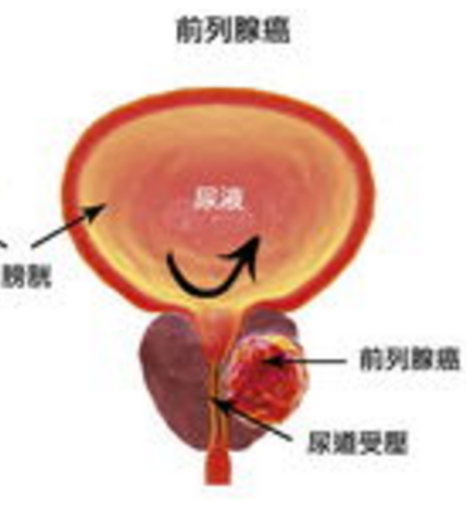 前列腺炎的症状是什么？药厂实拍