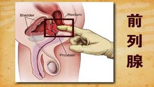 前列腺癌发病因素与年龄有关吗？如何治疗药厂实拍