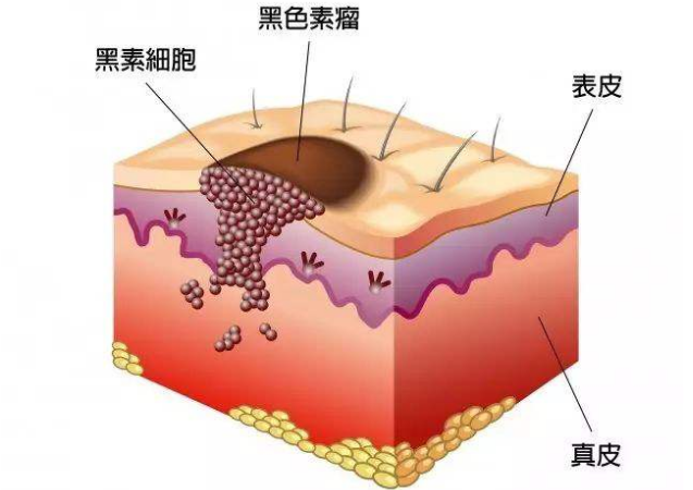 转移性黑色素瘤会扩散到肺部或其他器官吗药厂实拍