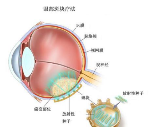 帕博利珠单抗适用于转移性黑色