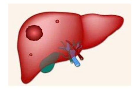 小,肝癌,是,早期,吗,的,症状,是什么,小,肝癌,