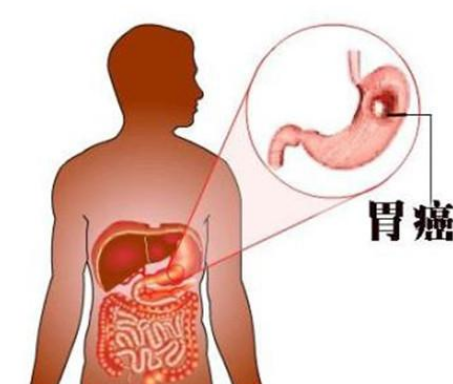 去除更多的淋巴结可提高胃癌生存率吗？药厂实拍