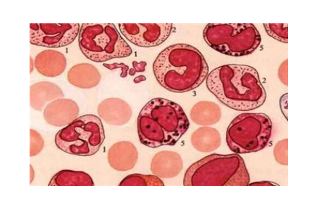 Blincytois费城染色体阴性（Ph-）ALL的生存率吗？药厂实拍