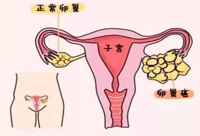 贝伐珠单抗降低了卵巢癌患者的死亡风险药厂实拍