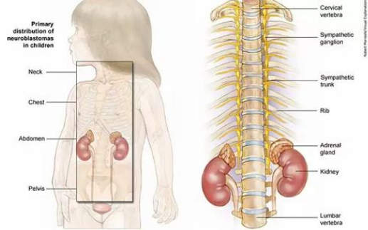 儿童神经母细胞瘤治疗现状如何