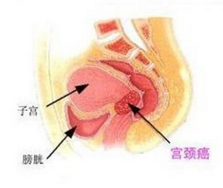 定期筛查子宫颈中的异常重要吗？药厂实拍