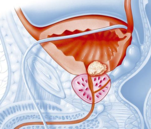 阿比特龙是前列腺癌的最佳选择
