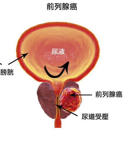 阿比特龙会引发肝脏损害吗？