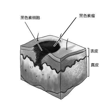 佐博伏治疗黑色素瘤的疗效如何