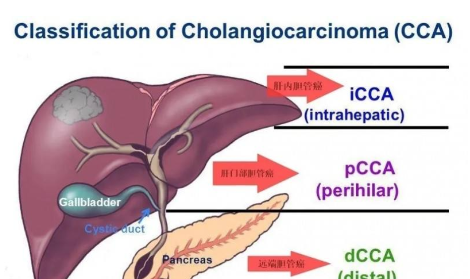 胆管癌