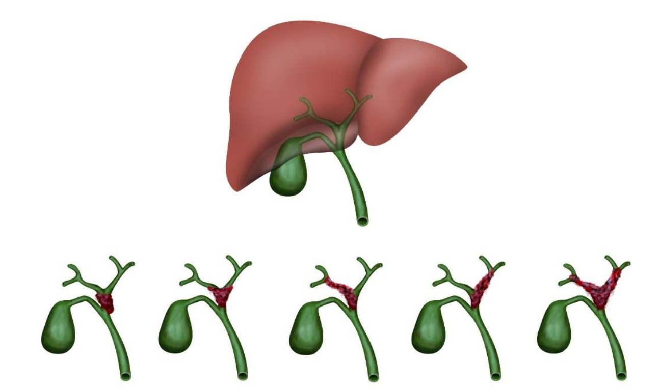 胆管癌晚期死前会很痛苦吗？