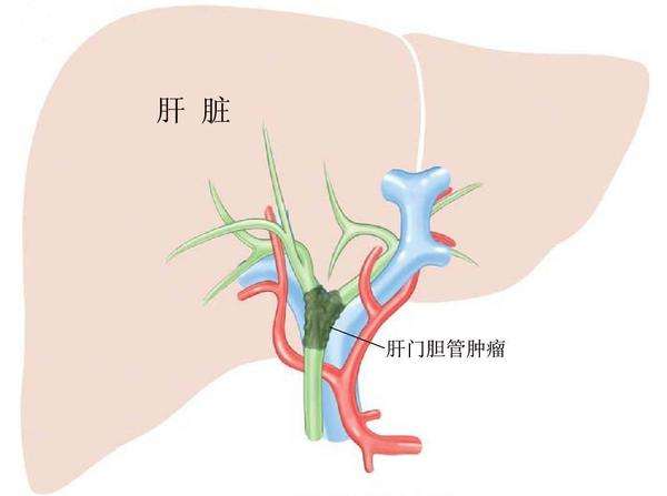 <b>胆管癌手术后会死吗？</b>药厂实拍