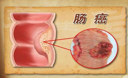 <b>结肠癌到了晚期有什么症状？</b>