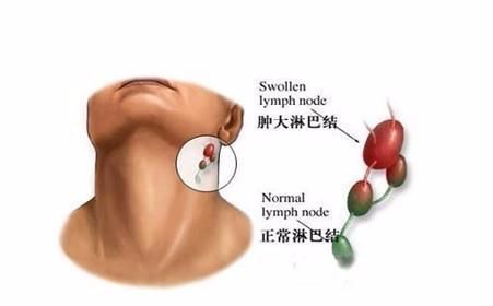 研究证实，治疗成人伯基特淋巴