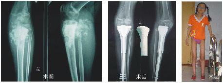 NCI研究提供了儿童骨肉瘤的遗传见解