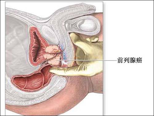 前列腺癌