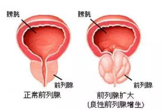 阿比特龙的真实疗效如何？药厂实拍