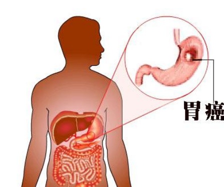 苹果酸舒尼替尼胶囊吃了会身体酸胀吗药厂实拍