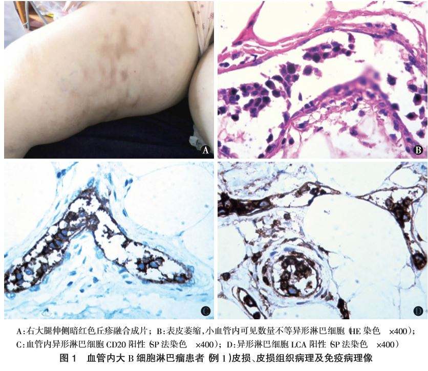 6条小淋巴细胞淋巴瘤（SLL）治疗方案介绍药厂实拍