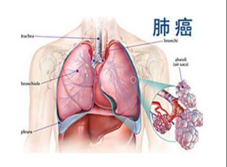 吃吉非替尼多久会有效果？药厂实拍