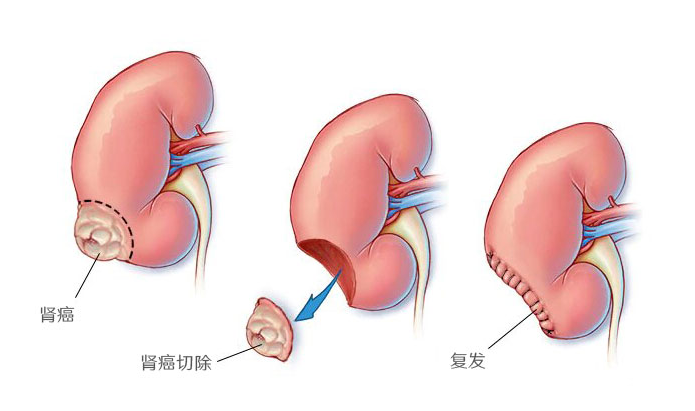 舒尼替尼